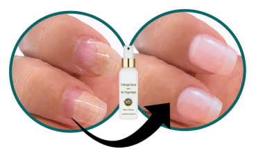nagelpilz-finger-fingernagelpilz-jenncosmetic